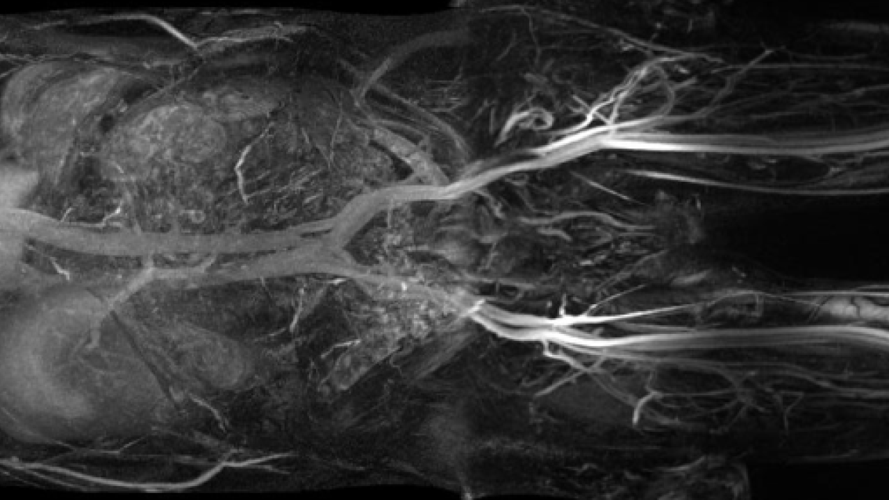 3T MRI using ablavar MRI contrast to show the organs in a black and white scan of a human